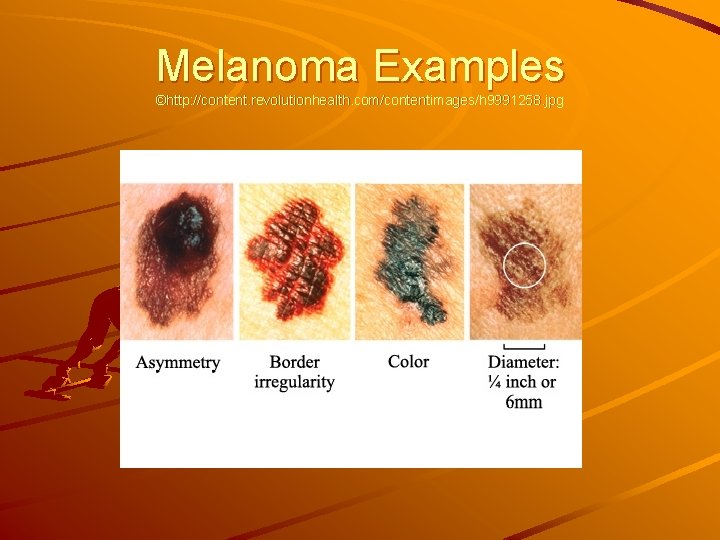 Melanoma Examples ©http: //content. revolutionhealth. com/contentimages/h 9991258. jpg 