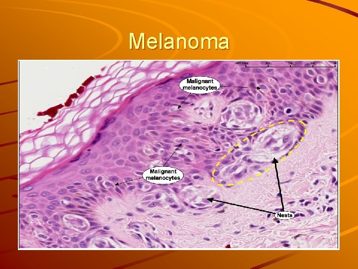Melanoma 