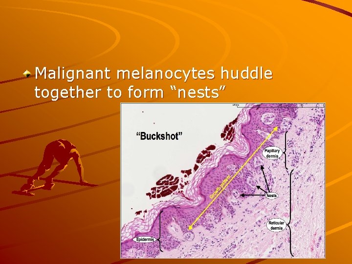 Malignant melanocytes huddle together to form “nests” 
