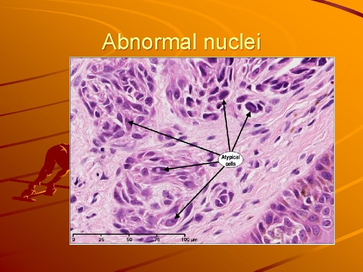 Abnormal nuclei 