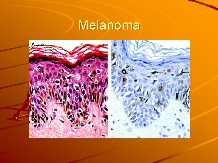 Melanoma 