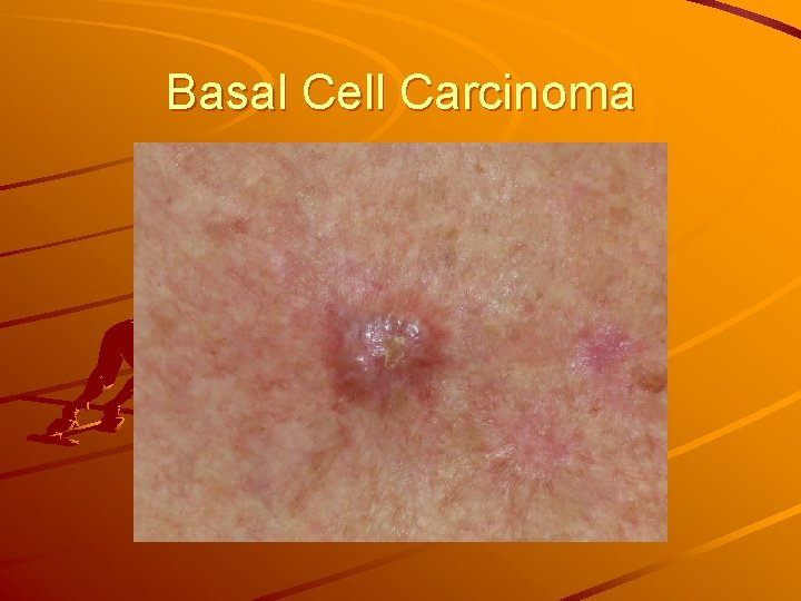 Basal Cell Carcinoma 