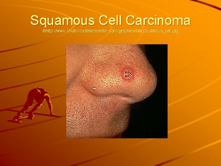 Squamous Cell Carcinoma ©http: //www. southcoastmedcenter. com/graphics/lab/squamous_cell. jpg 