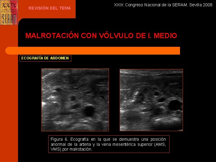 REVISIÓN DEL TEMA XXIX Congreso Nacional de la SERAM. Sevilla 2008 MALROTACIÓN CON VÓLVULO
