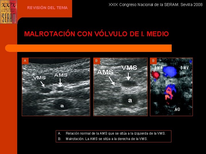 XXIX Congreso Nacional de la SERAM. Sevilla 2008 REVISIÓN DEL TEMA MALROTACIÓN CON VÓLVULO