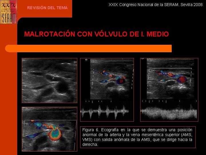 REVISIÓN DEL TEMA XXIX Congreso Nacional de la SERAM. Sevilla 2008 MALROTACIÓN CON VÓLVULO