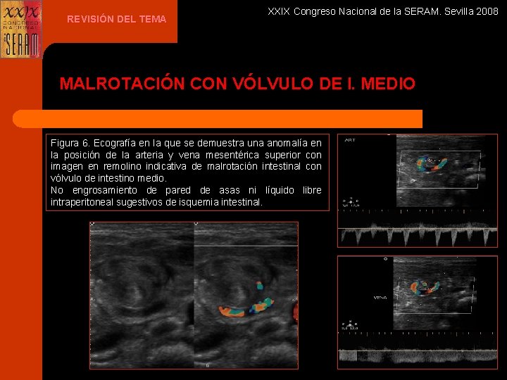 REVISIÓN DEL TEMA XXIX Congreso Nacional de la SERAM. Sevilla 2008 MALROTACIÓN CON VÓLVULO