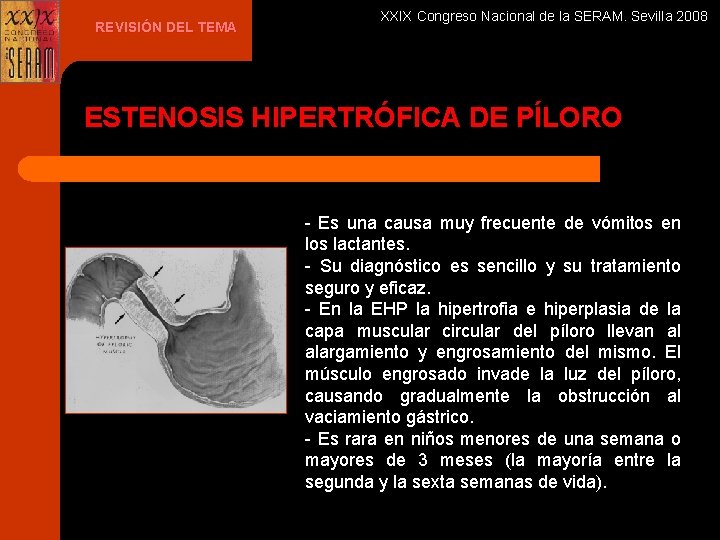REVISIÓN DEL TEMA XXIX Congreso Nacional de la SERAM. Sevilla 2008 ESTENOSIS HIPERTRÓFICA DE