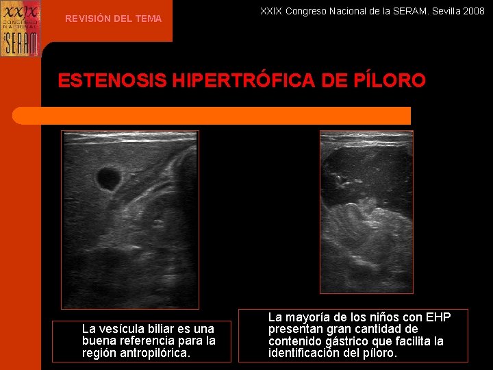 REVISIÓN DEL TEMA XXIX Congreso Nacional de la SERAM. Sevilla 2008 ESTENOSIS HIPERTRÓFICA DE