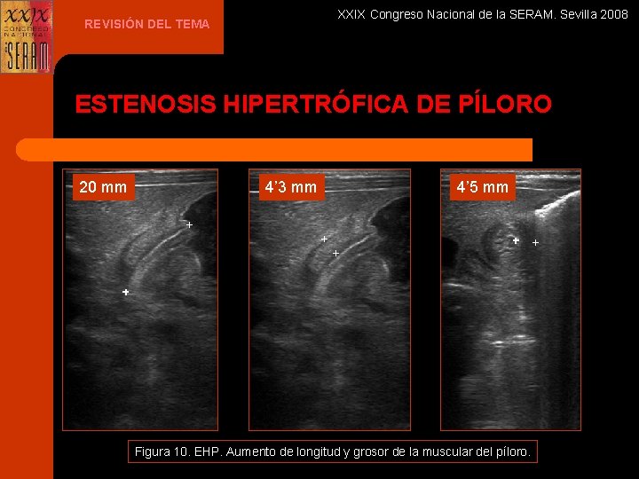 XXIX Congreso Nacional de la SERAM. Sevilla 2008 REVISIÓN DEL TEMA ESTENOSIS HIPERTRÓFICA DE