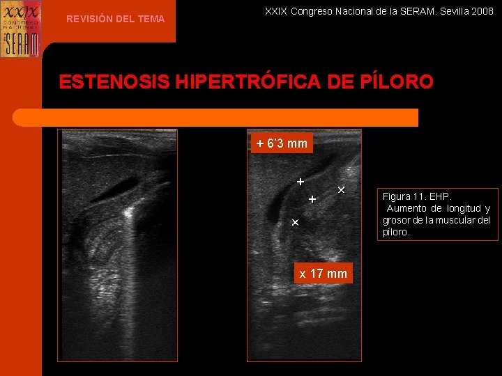REVISIÓN DEL TEMA XXIX Congreso Nacional de la SERAM. Sevilla 2008 ESTENOSIS HIPERTRÓFICA DE