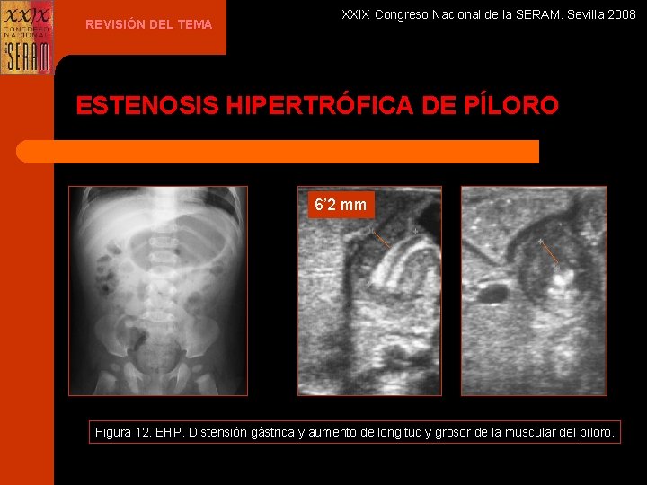 REVISIÓN DEL TEMA XXIX Congreso Nacional de la SERAM. Sevilla 2008 ESTENOSIS HIPERTRÓFICA DE