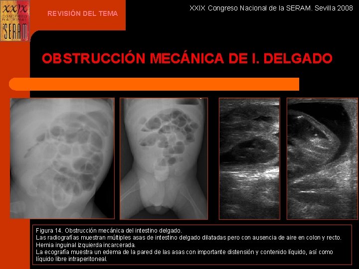 REVISIÓN DEL TEMA XXIX Congreso Nacional de la SERAM. Sevilla 2008 OBSTRUCCIÓN MECÁNICA DE