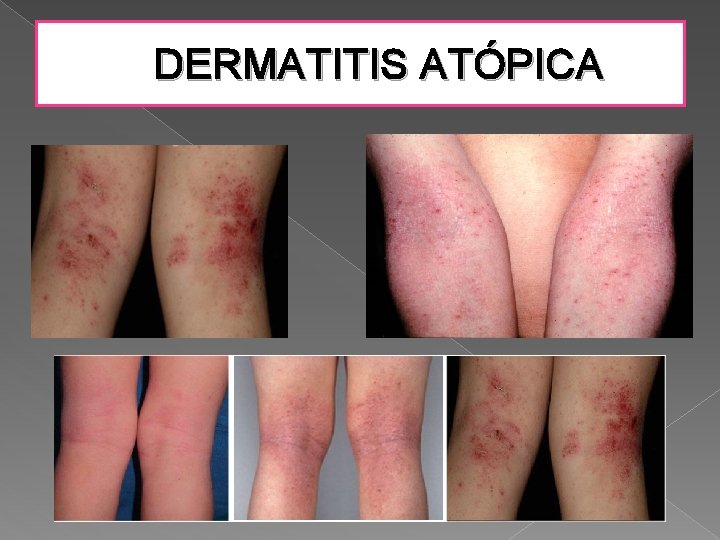 DERMATITIS ATÓPICA DERMATITIS ATÓPICA