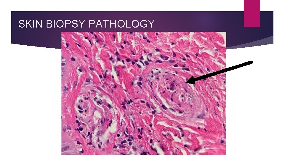 SKIN BIOPSY PATHOLOGY 