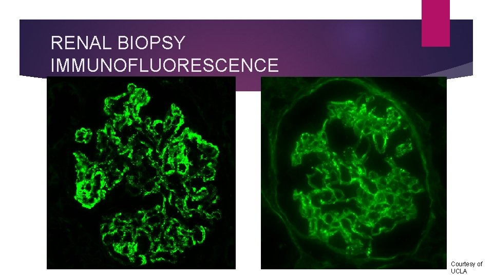 RENAL BIOPSY IMMUNOFLUORESCENCE Courtesy of UCLA 