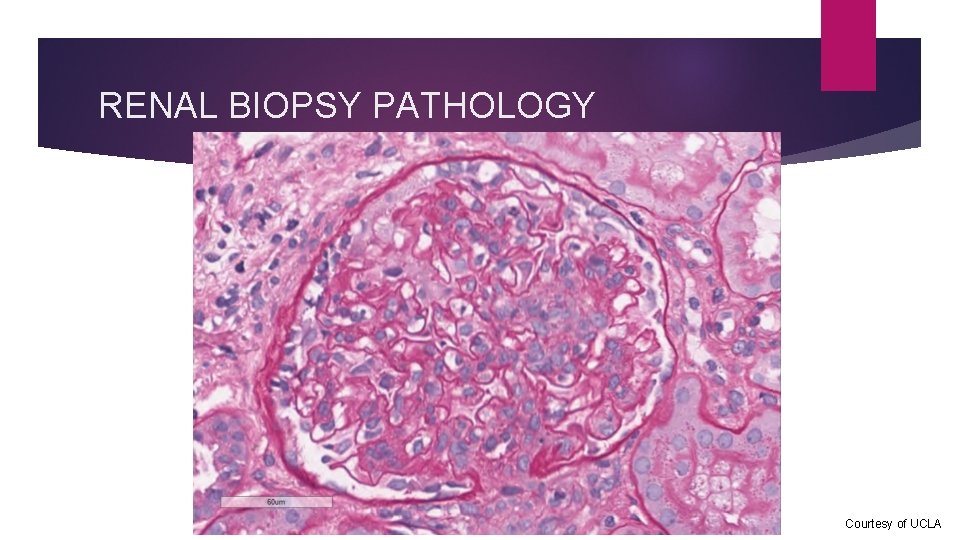 RENAL BIOPSY PATHOLOGY Courtesy of UCLA 