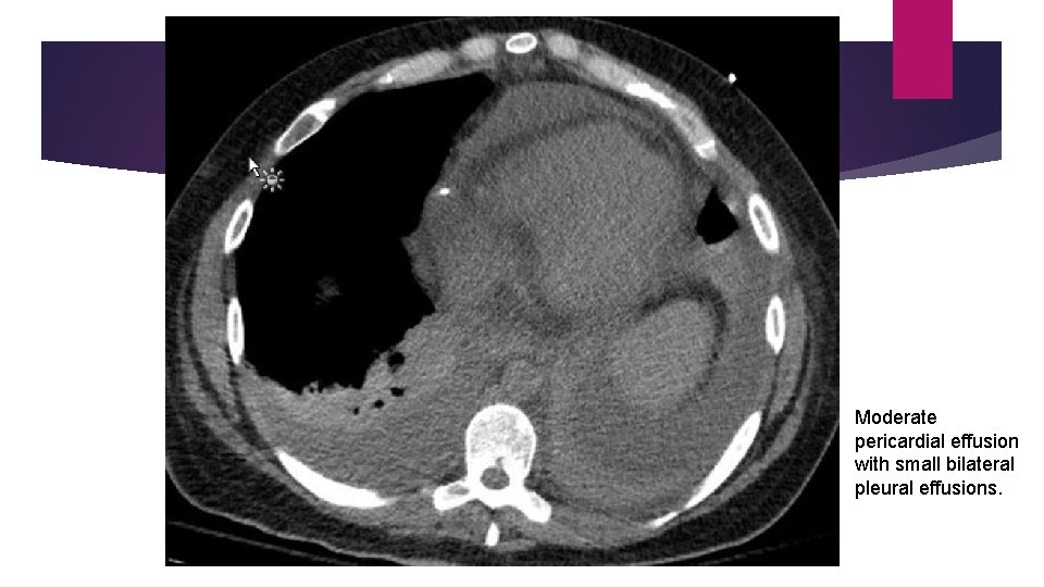 Moderate pericardial effusion with small bilateral pleural effusions. 