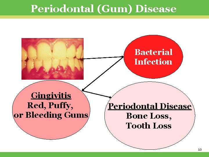 Periodontal (Gum) Disease Bacterial Infection Gingivitis Red, Puffy, or Bleeding Gums Periodontal Disease Bone