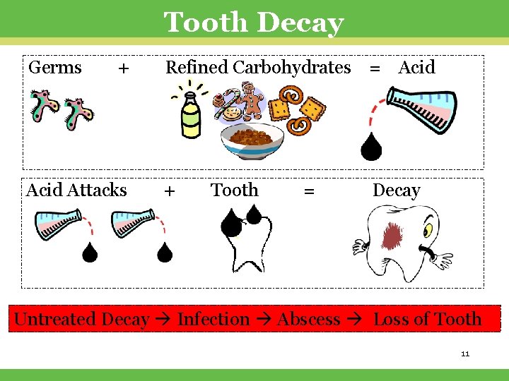 Tooth Decay Germs + Refined Carbohydrates = Acid Attacks + Tooth = Decay Untreated