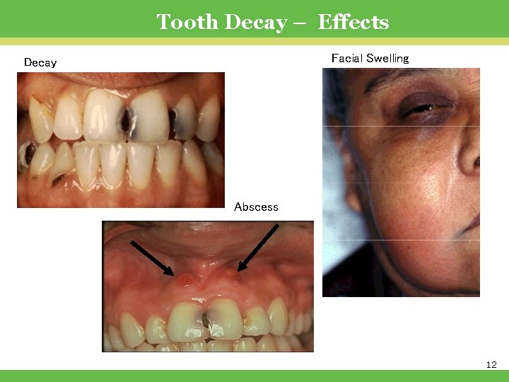 Tooth Decay – Effects Facial Swelling Decay Abscess WDSF 2011 © 12 