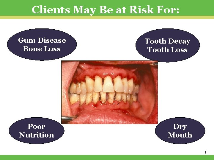 Clients May Be at Risk For: Gum Disease Bone Loss Poor Nutrition Tooth Decay