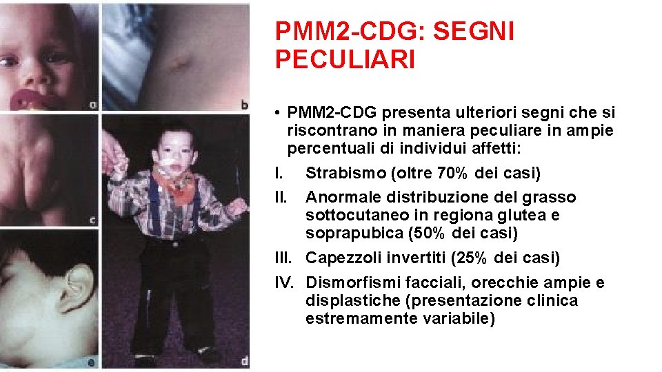 PMM 2 -CDG: SEGNI PECULIARI • PMM 2 -CDG presenta ulteriori segni che si