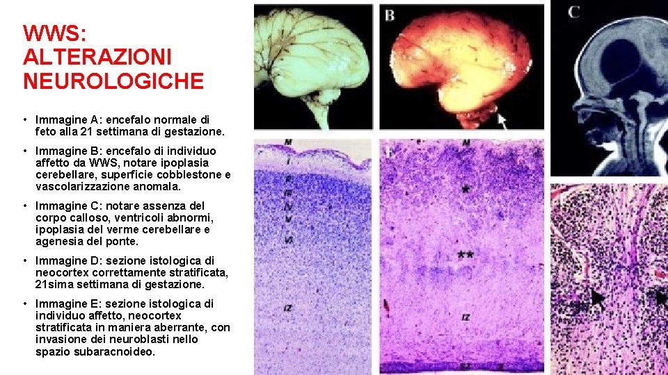 WWS: ALTERAZIONI NEUROLOGICHE • Immagine A: encefalo normale di feto alla 21 settimana di