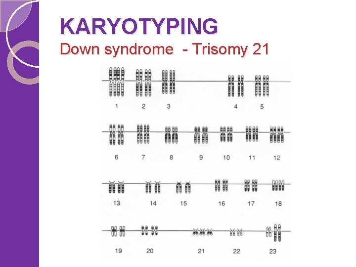 KARYOTYPING Down syndrome - Trisomy 21 