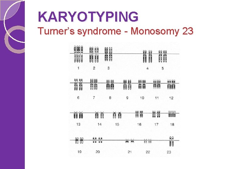 KARYOTYPING Turner’s syndrome - Monosomy 23 