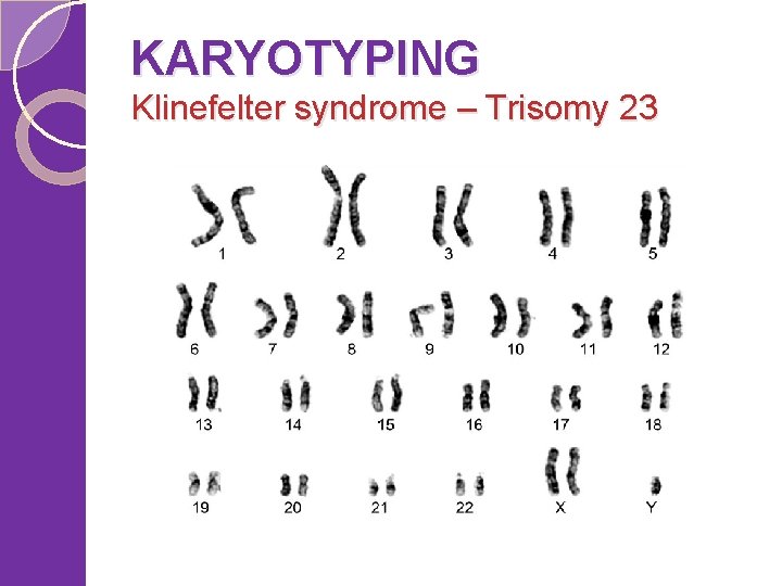 KARYOTYPING Klinefelter syndrome – Trisomy 23 