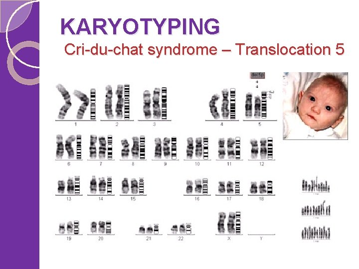 KARYOTYPING Cri-du-chat syndrome – Translocation 5 