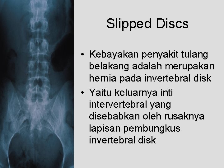 Slipped Discs • Kebayakan penyakit tulang belakang adalah merupakan hernia pada invertebral disk •