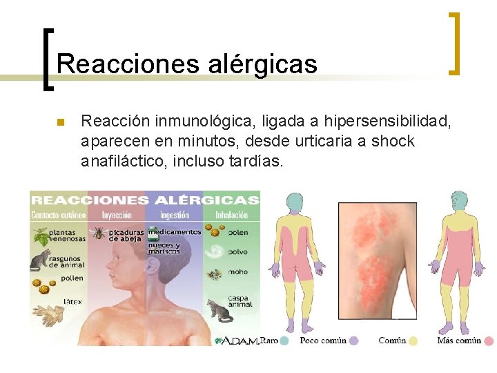 Reacciones alérgicas n Reacción inmunológica, ligada a hipersensibilidad, aparecen en minutos, desde urticaria a Reacciones alérgicas n Reacción inmunológica, ligada a hipersensibilidad, aparecen en minutos, desde urticaria a