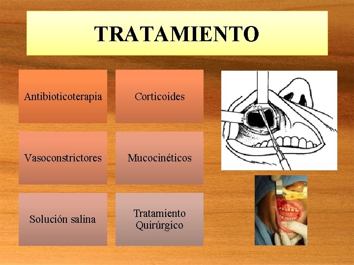 TRATAMIENTO Antibioticoterapia Corticoides Vasoconstrictores Mucocinéticos Solución salina Tratamiento Quirúrgico 