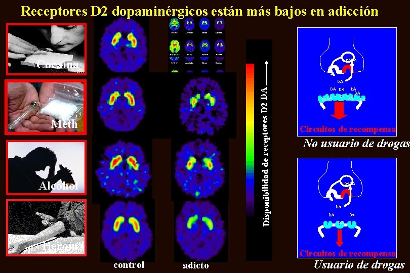 Receptores D 2 dopaminérgicos están más bajos en adicción Cocaína DADA Disponibilidad de receptores