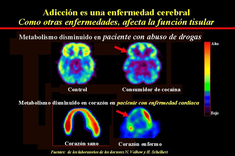 Adicción es una enfermedad cerebral Como otras enfermedades, afecta la función tisular Metabolismo disminuido