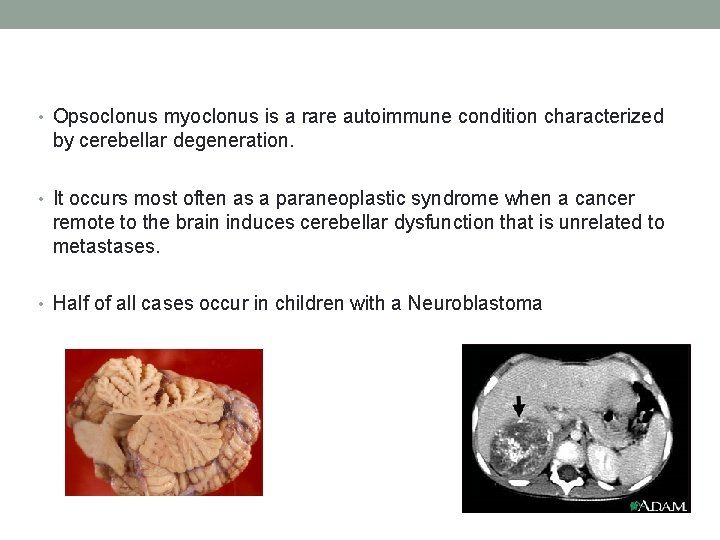  • Opsoclonus myoclonus is a rare autoimmune condition characterized by cerebellar degeneration. •