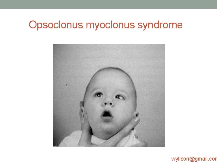 Opsoclonus myoclonus syndrome wyllcon@gmail. com 