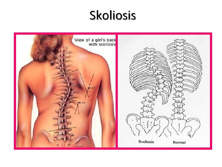 Skoliosis 