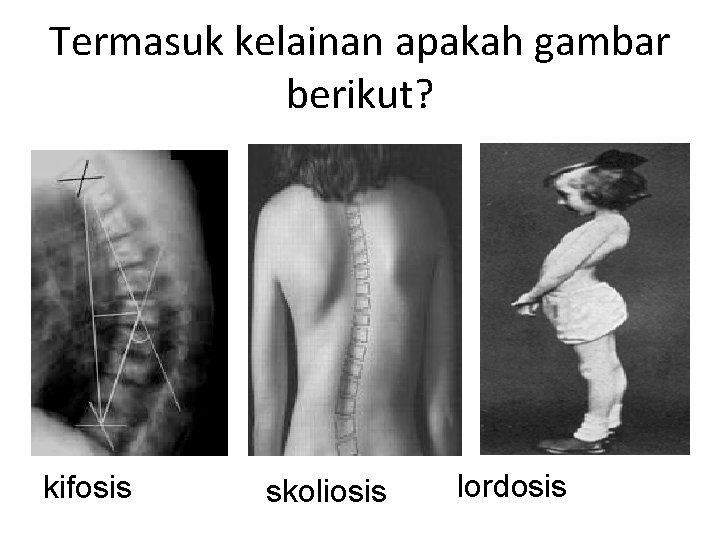 Termasuk kelainan apakah gambar berikut? kifosis skoliosis lordosis 