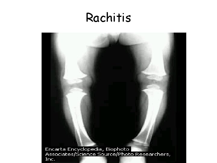 Rachitis 