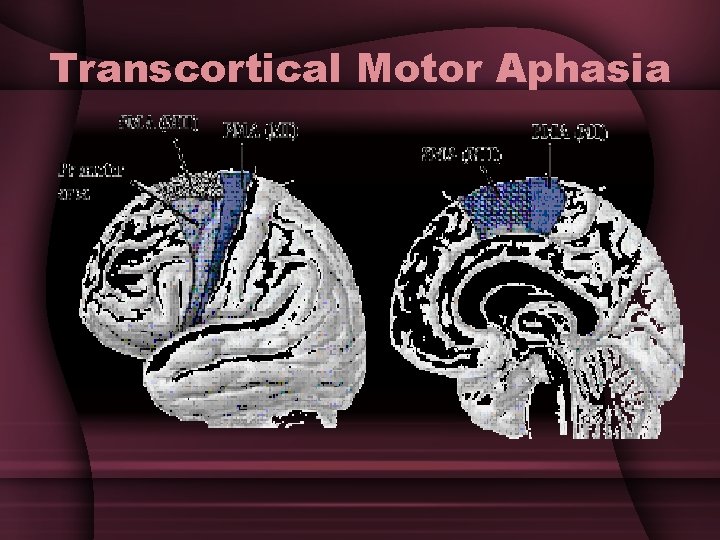 Transcortical Motor Aphasia 