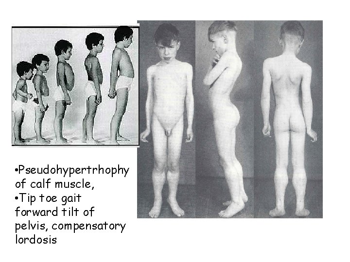  • Pseudohypertrhophy of calf muscle, • Tip toe gait forward tilt of pelvis,