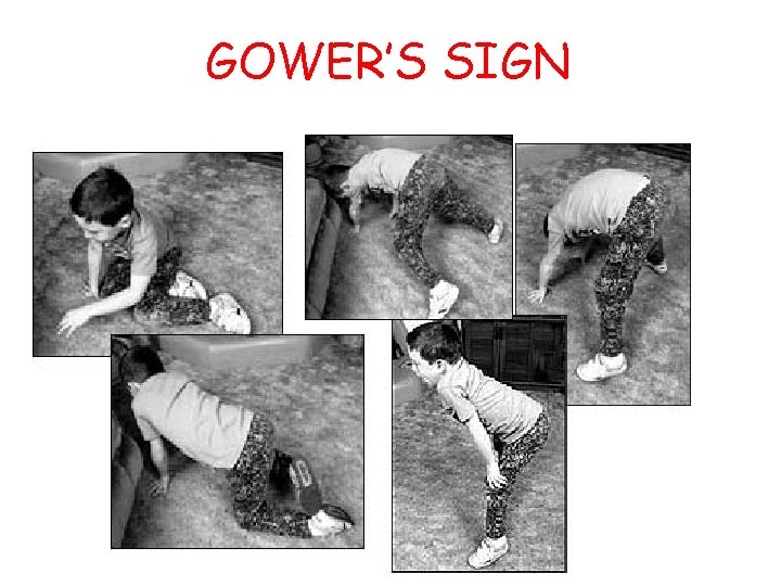 GOWER’S SIGN 