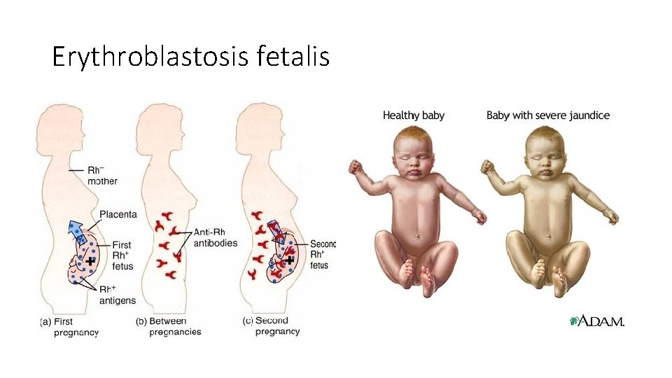 Erythroblastosis fetalis 