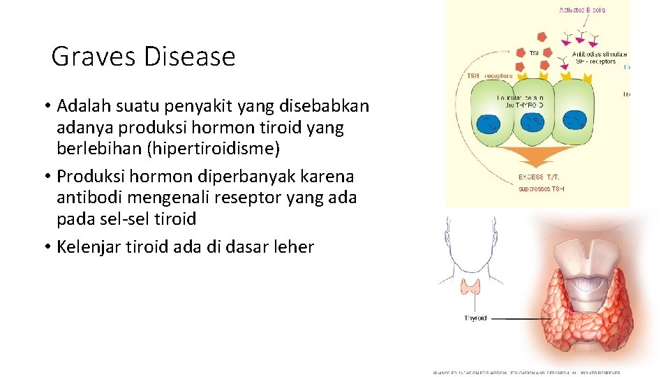 Graves Disease • Adalah suatu penyakit yang disebabkan adanya produksi hormon tiroid yang berlebihan