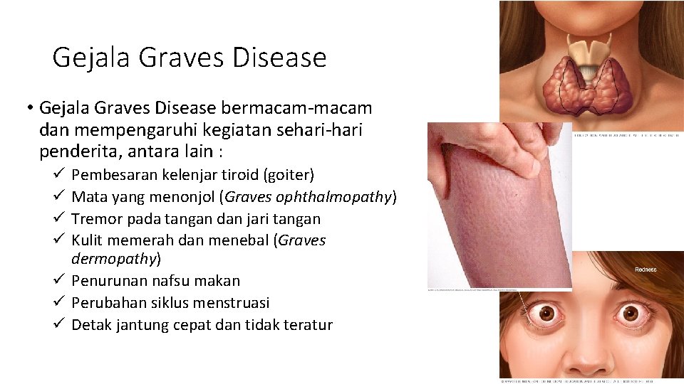 Gejala Graves Disease • Gejala Graves Disease bermacam-macam dan mempengaruhi kegiatan sehari-hari penderita, antara