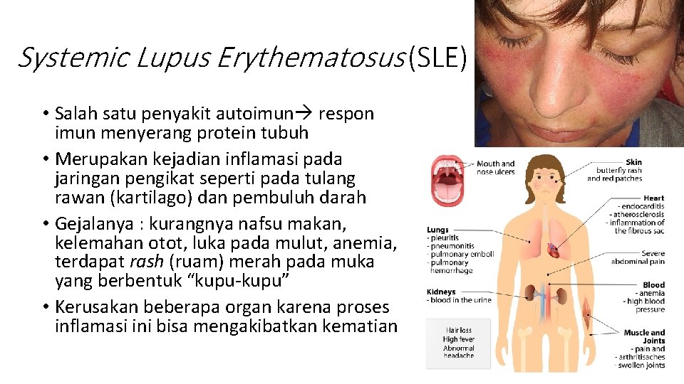 Systemic Lupus Erythematosus (SLE) • Salah satu penyakit autoimun respon imun menyerang protein tubuh