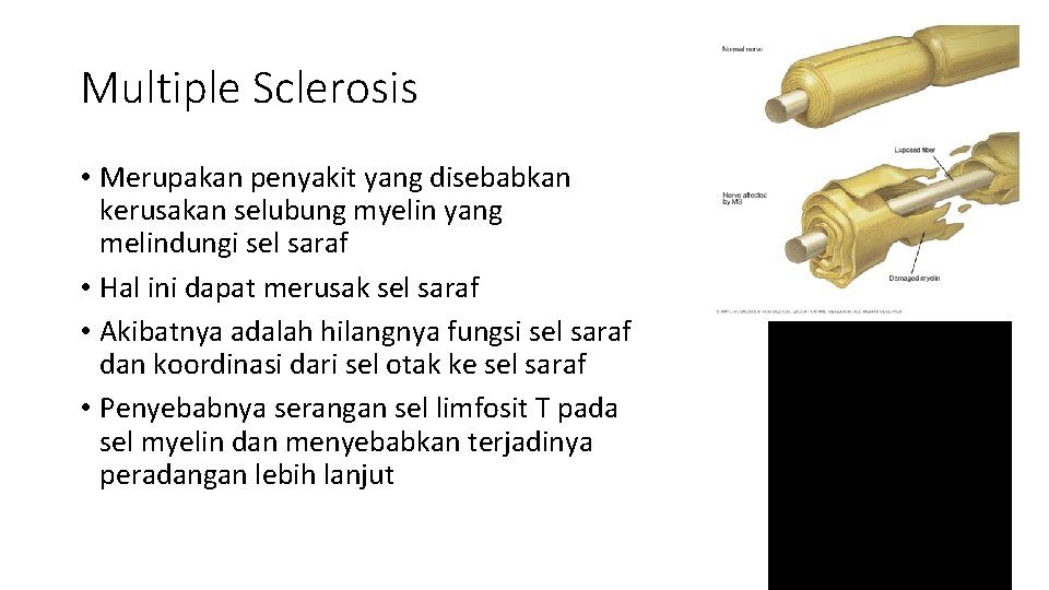 Multiple Sclerosis • Merupakan penyakit yang disebabkan kerusakan selubung myelin yang melindungi sel saraf